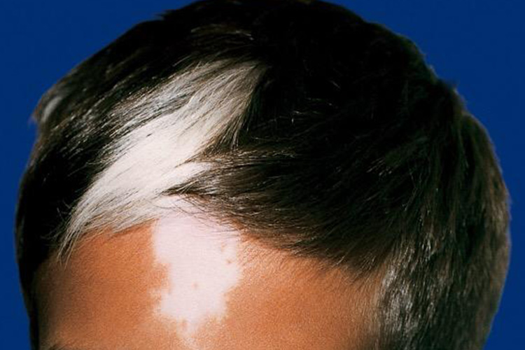 白癜风样白斑图