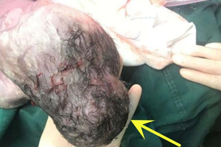 头皮血肿头部大包图