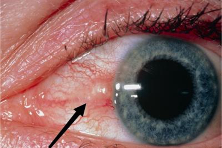 进展期翼状胬肉结膜小疙瘩图