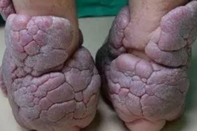 胫前黏液性水肿脚部结节图