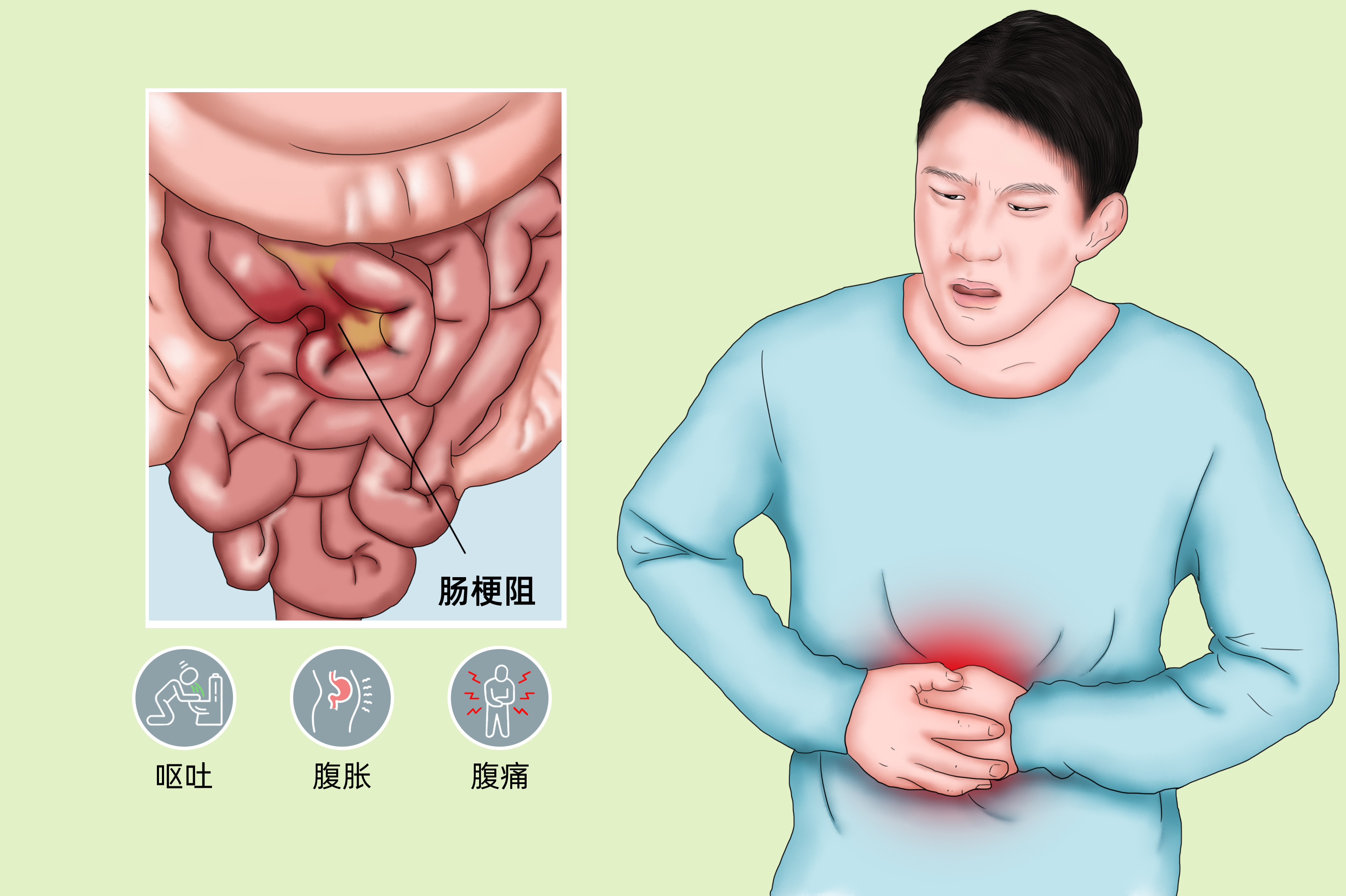 肠梗阻怎么能快速排便排气